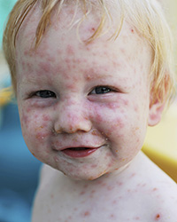 Chickenpox cover a child's face